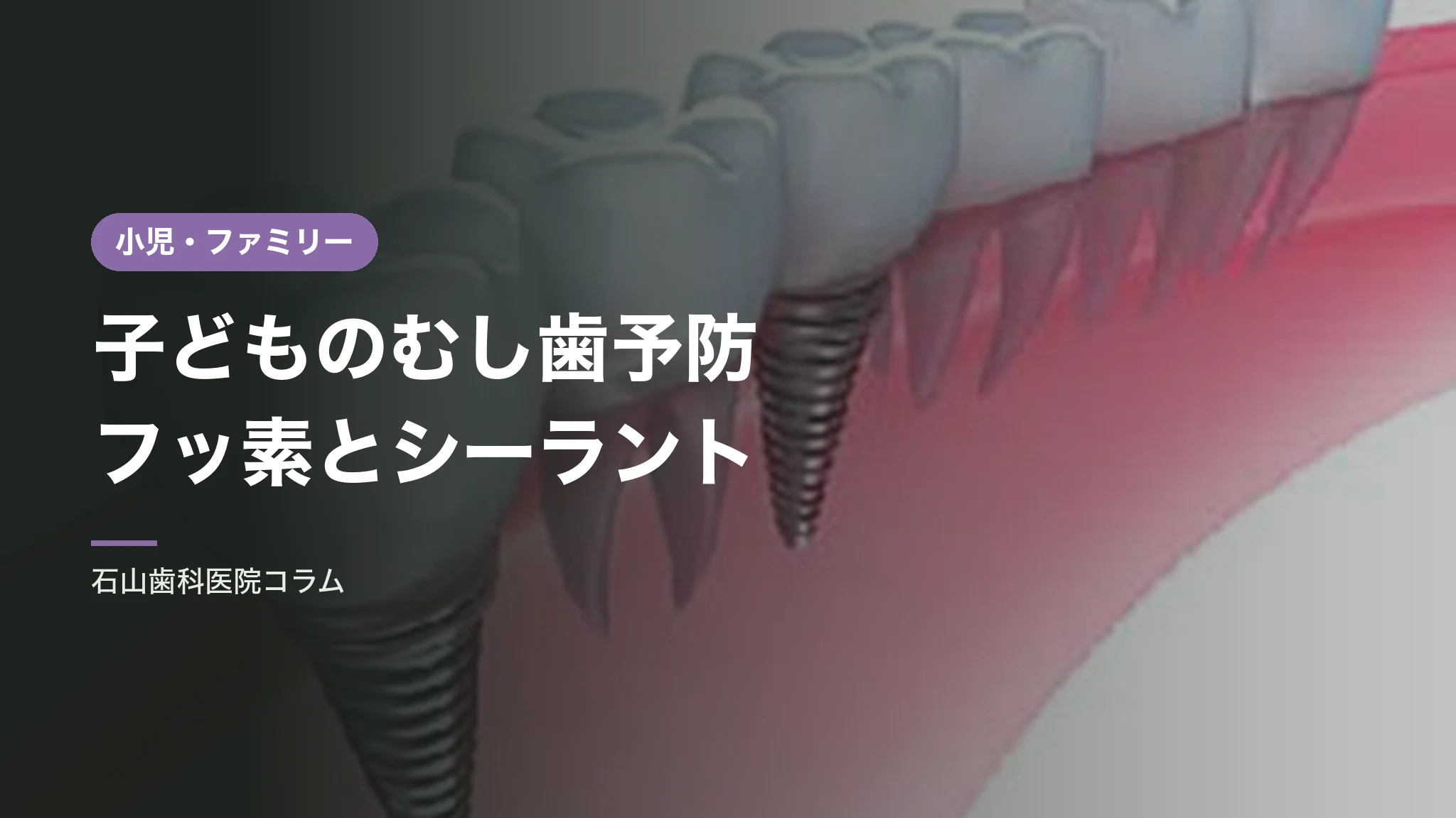 子どものむし歯予防|フッ素とシーラント
