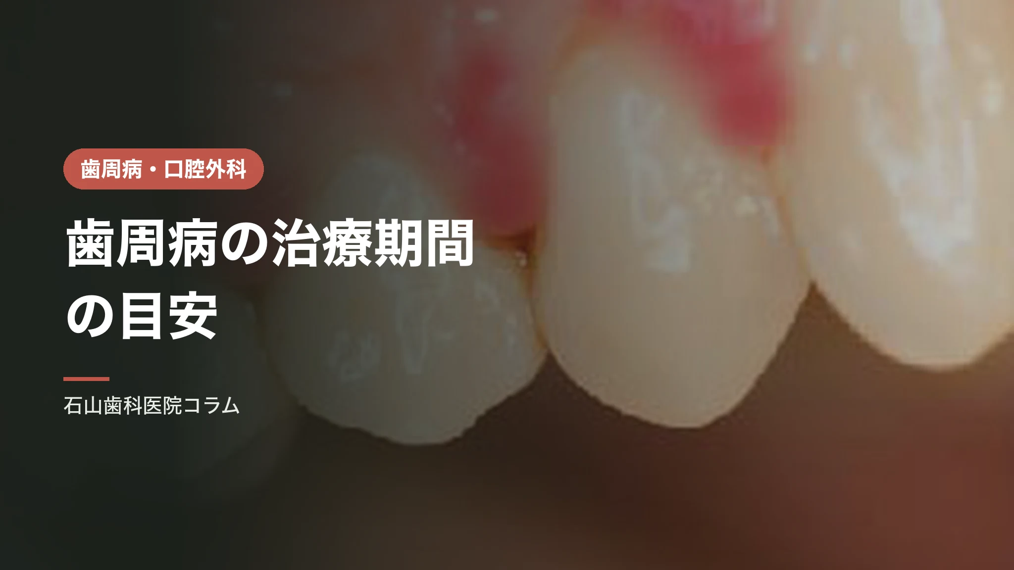 歯周病の治療期間の目安|進行度別の通院回数